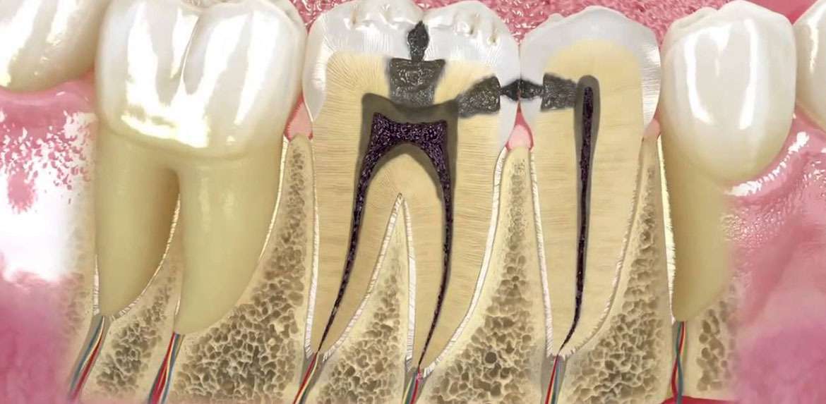 Endodonti (Kanal Tedavisi)